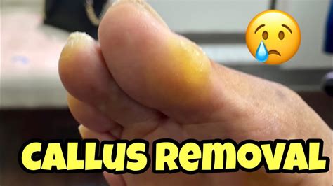 Extremely Satisfying Callus Removal From The Foot Youtube