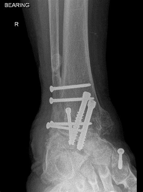 Ankle Joint Fusion In Sydney Dr A Scott Newman