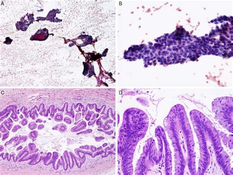 This Intraductal Papillary Mucinous Neoplasm Produced A Cellular Smear Download Scientific