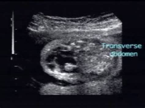 Klippel Trenaunay Weber Syndrome Ultrasoundpaedia