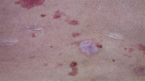 Skin Cancer Rash: Itchiness and Symptoms