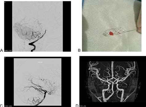 The Occluded Basilar Artery Is Visualized By Digital Subtraction