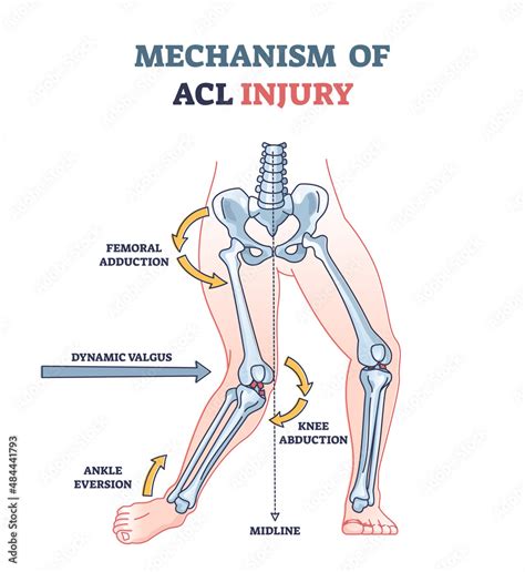 Fototapeta Mechanism Of Acl Injury As Knee Trauma Anatomical