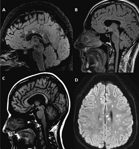 Susac Syndrome A Differential Diagnosis Of White Matter Lesions