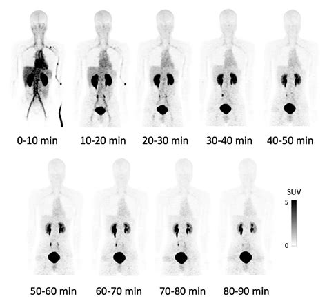 Normal Pet Scan Images