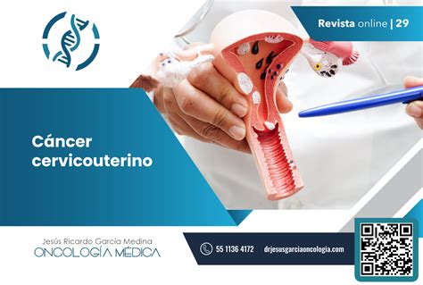 Cáncer Cervicouterino Dr Jesús Ricardo García Medina