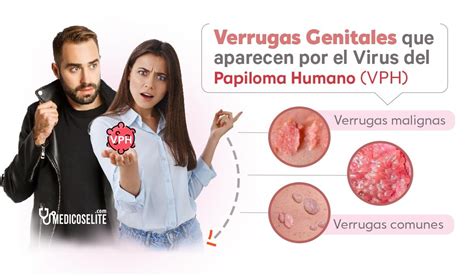 VIRUS Del PAPILOMA HUMANO Verrugas Sintomas TRATAMIENTO Y 49 OFF