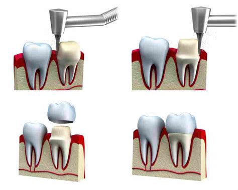 Diferencias de las carillas y las coronas dentales cuándo se indican