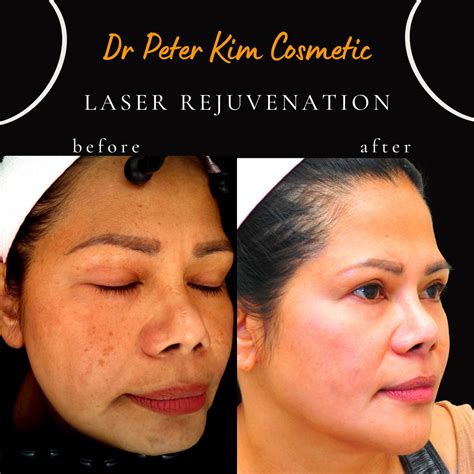 Laser Skin Whitening Rejuvenation Dr Peter Kim Surgery Skin