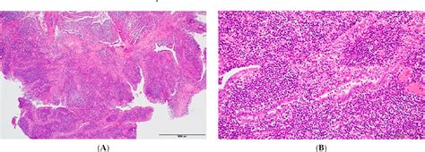 Figure From Chlamydia Peritonitis Mimicking Juvenile Carcinomatous