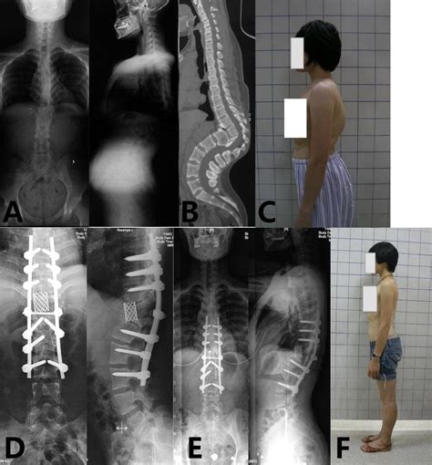 Female Years Old Post Tuberculous Kyphosis Of T A