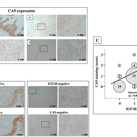 Igf1r And Ca9 Expression In Pdac A Representative Staining Of Ca9 Download Scientific