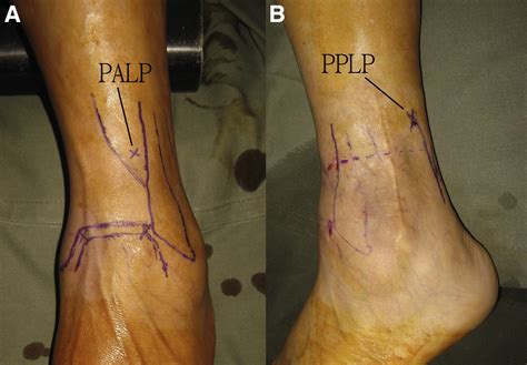 Endoscopic Distal Tibiofibular Syndesmosis Arthrodesis Arthroscopy