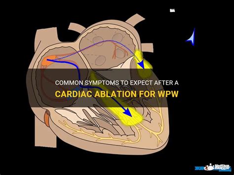 Common Symptoms To Expect After A Cardiac Ablation For Wpw Medshun