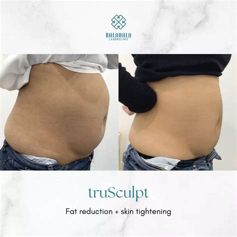 Trusculpt Body Sculpting Adelaide Balabala Laser Clinic