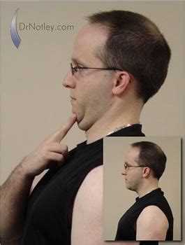 Neck Retraction Exercise | Winnipeg Chiropractic and Sports Injury Care