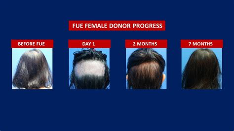 Fue Hair Transplant Before After Hair Transplant Centre Malaysia