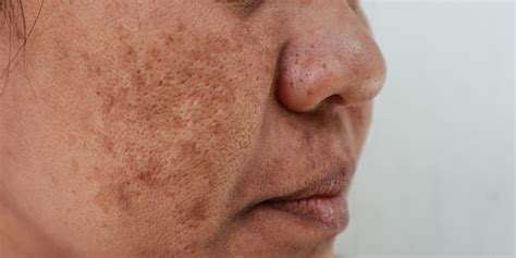 Melasma Treatments | San Luis Obispo | Coastal Dermatology