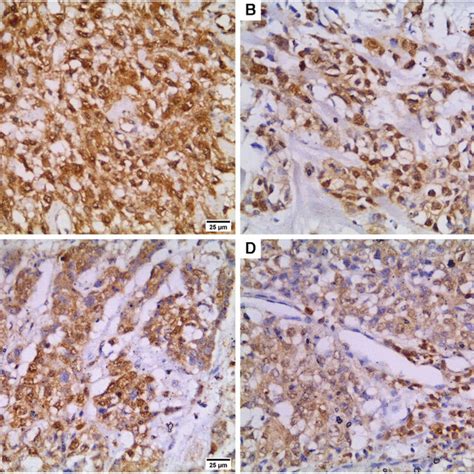 Beclin 1 And Bcl 2 Immunostaining In TNBC Cases 400 A Low