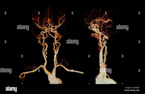 Cta Brain Or Ct Angiography Of The Brain 3d Rendering Image For Diagnosis Cerebral Artery