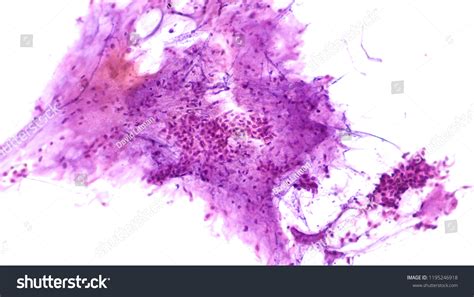 Fine Needle Aspiration Fna Cytology Pleomorphic Nh C S N