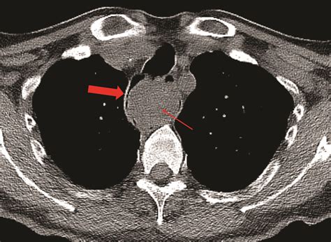 Large Recurrent Esophageal Fibrovascular Polyp Applied Radiology