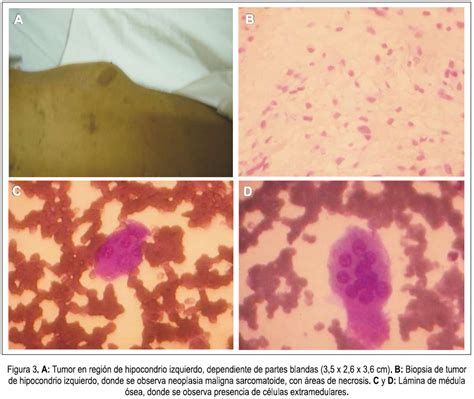 Neurofibromatosis Tipo Asociado A Tumor Maligno De La Vaina De Nervio