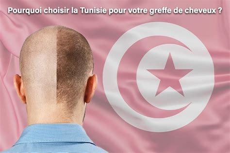 Greffe de Cheveux en Tunisie Résolvez vos problèmes de calvitie