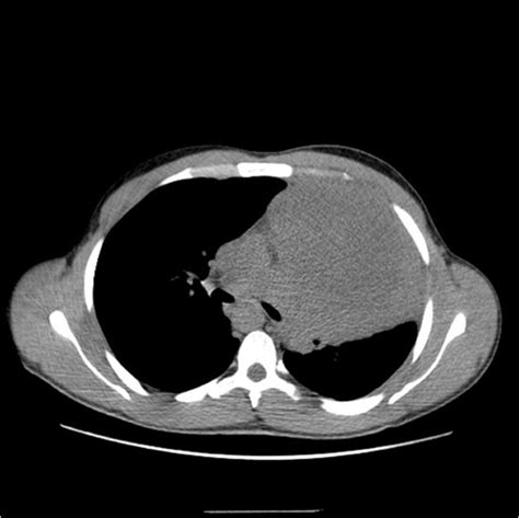 Complete Histologic Response To Chemotherapy In A Patient With A