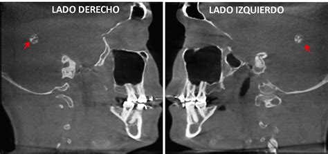 Calcificación de los Plexos Coroideos Dento Metric Radiología