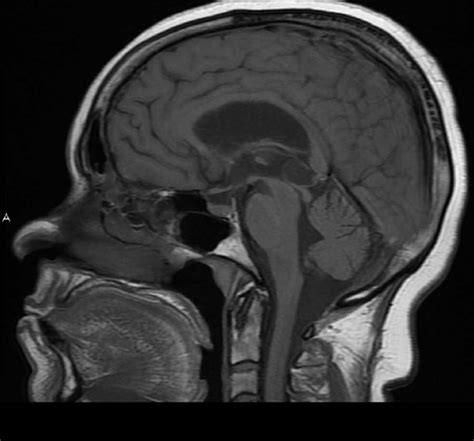 Pineal Gland Cyst Neuro Mr Case Studies Ctisus Ct Scanning