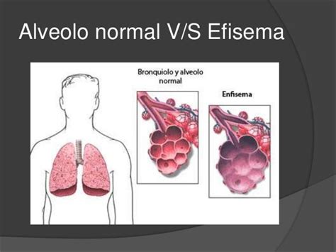 Enfisema Pulmonar