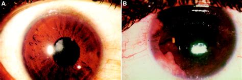 Ocular Involvement In Sarcoidosis British Journal Of Ophthalmology