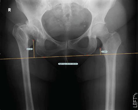 Pre A And Postoperative B Radiographs Of Case 2 Preoperative Lld