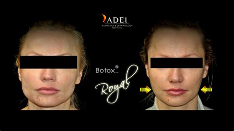 Botox En Maseteros Youtube