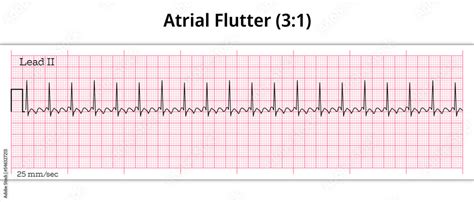 Ecg Atrial Flutter 31 8 Second Ecg Paper Stock Vector Adobe Stock