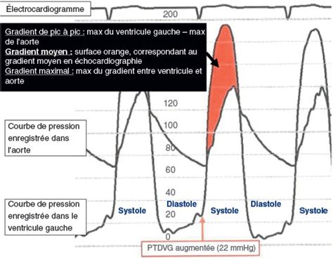 Chapitre Item Valvulopathies Soci T Fran Aise De Cardiologie