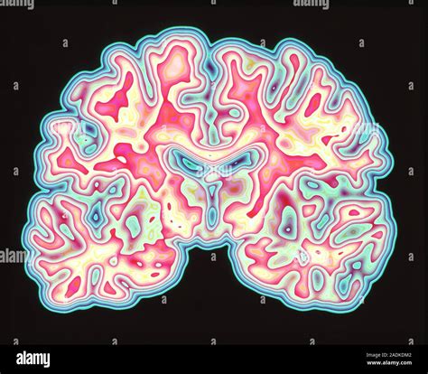 Brain Coloured Computed Tomography Ct Scan Of A Section Through A