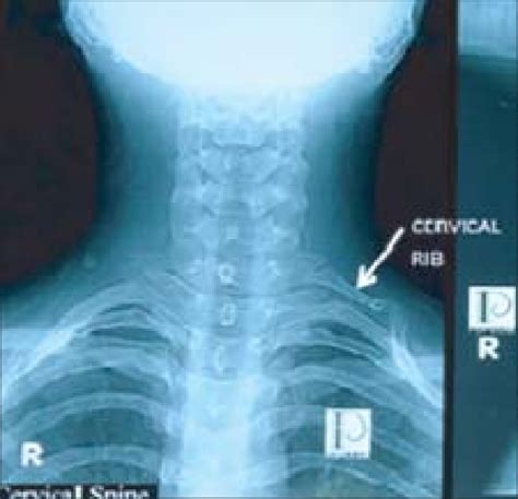 Plain X Ray Showing The Left Sided Cervical Rib Download Scientific Diagram