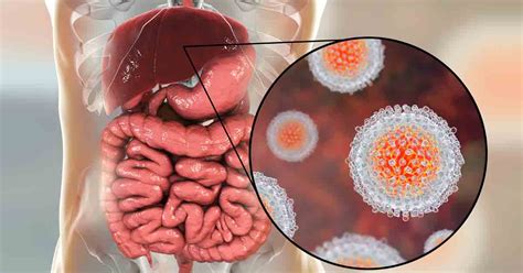 Hepatitis C Introduction Causes Symptoms And Treatment