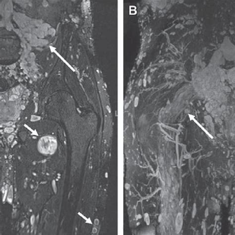 Normal Sciatic Nerve A Axial T1 Mr Images Just Below The Greater