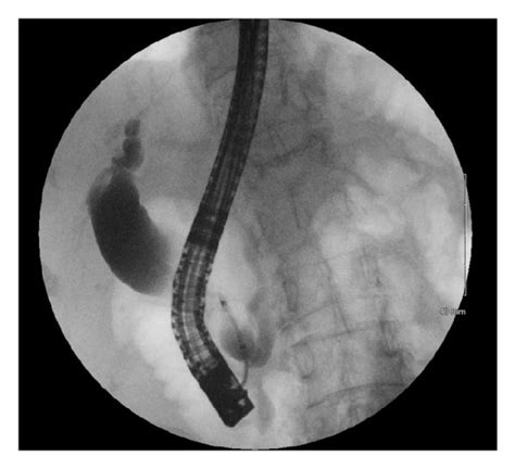 An Mrcp Image Is Shown In A Demonstrating The Type 1c Choledochal Download Scientific