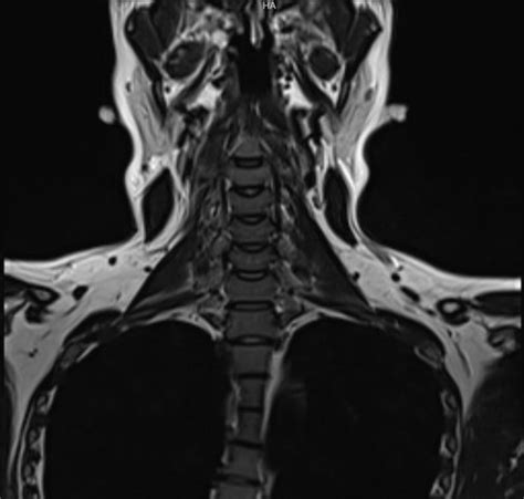 Resonancia Magnética Columna Cervical Fase Contrastada UniRad