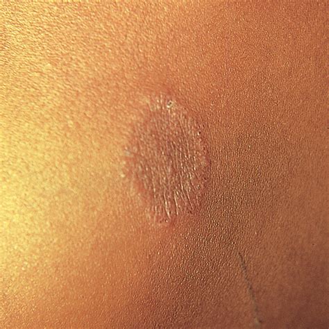 Tinea Corporis Drbeckmann