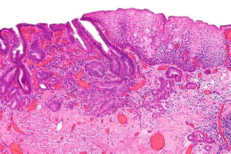 Esophageal Cancer (Esophageal Carcinoma) — Staging and Prognosis