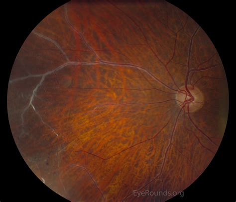 Atlas Entry Vascular Sheathing In Idiopathic Retinal Vasculitis