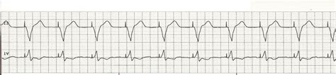 EKG Rhythm Strips 70