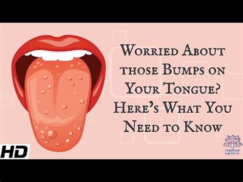 Bumps On Back Of Tongue What Causes Them FAQs