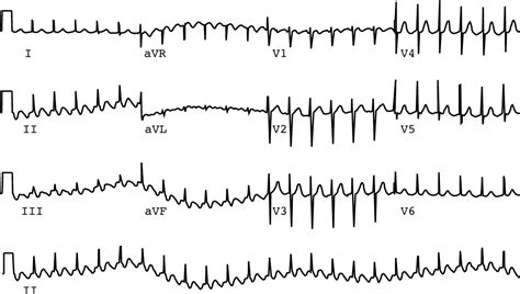 Treatment Of Atrial Flutter Heart