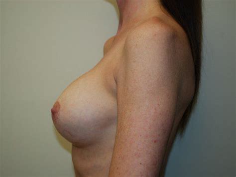 Breast Revision Before After Gallery Allen Doezie Md Facs